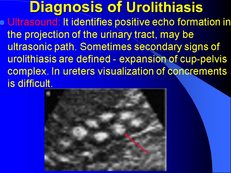 Diagnosis of Urolithiasis Ultrasound: It identifies positive echo formation in the projection of the Diagnosis of Urolithiasis Ultrasound: It identifies positive echo formation in the projection of the